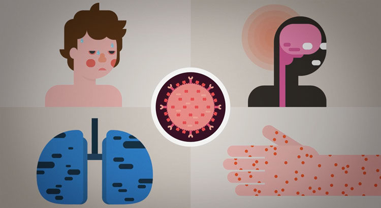 measles infection