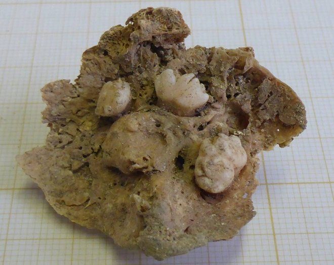 Ovarian teratoma