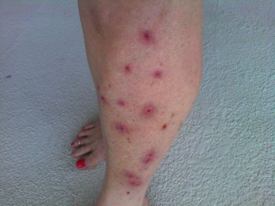 Click to enlarge skin rash