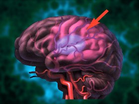 Brain Damage