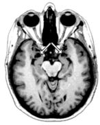 brain scan amygdala