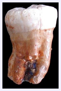 Click to enlarge Neanderthal's tooth