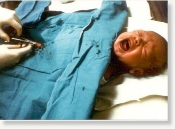 Click to enlarge circumcision