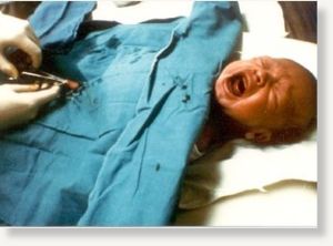 circumcision