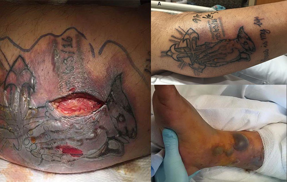 Click to enlarge Vibrio vulnificus infection, infected tattoo
