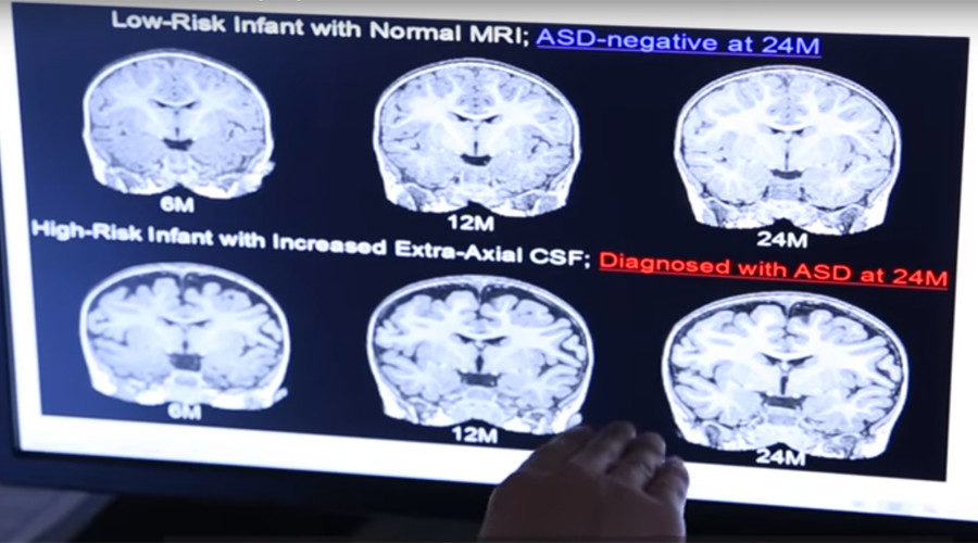 Click to enlarge Autism