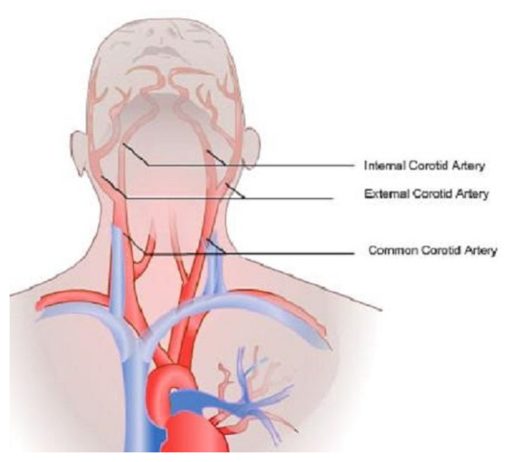Click to enlarge Common Cartoid Arteries