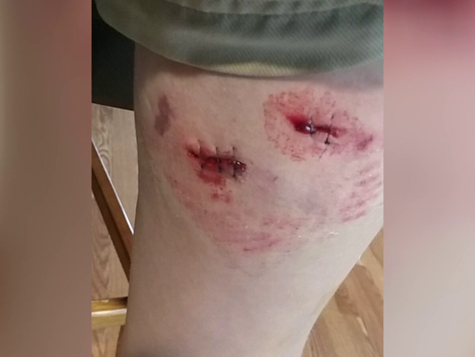 Click to enlarge dog bite
