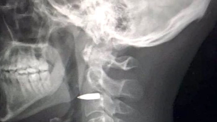 Click to enlarge Bullet in neck