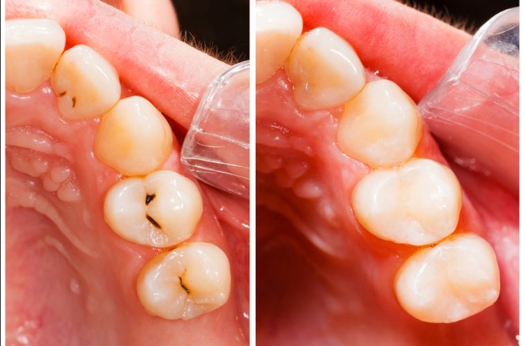 Click to enlarge dirty and clean teeth