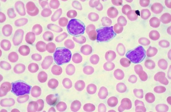 Click to enlarge leukemia cells