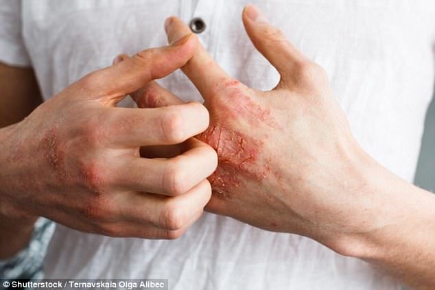 Click to enlarge Shedding light on cure: University of Edinburgh scientists say their findings pave the way for new therapies for the skin condition (pictured) which mimic the effects of the sun's rays