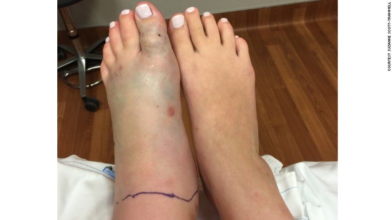 snake bite foot