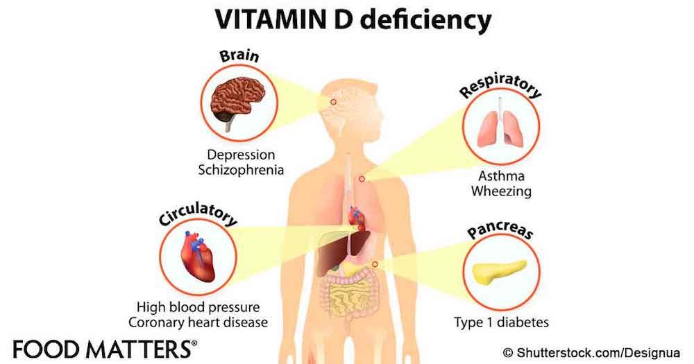 Vitamin D deficiency