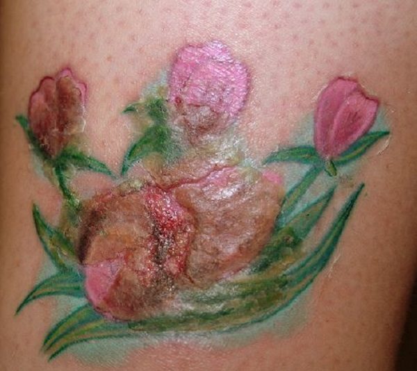infected tatoo