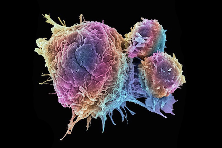cancer tumor