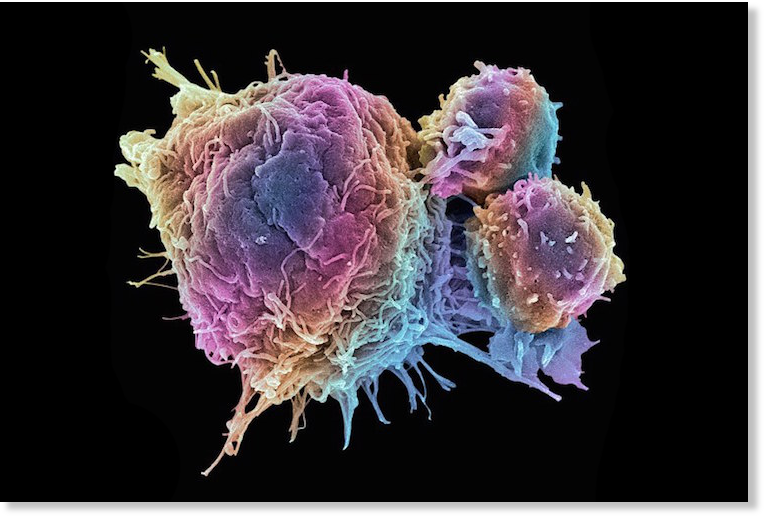 cancer tumor
