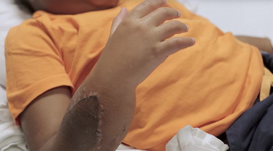 Click to enlarge zion harvey hand transplants