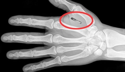 microchip implant