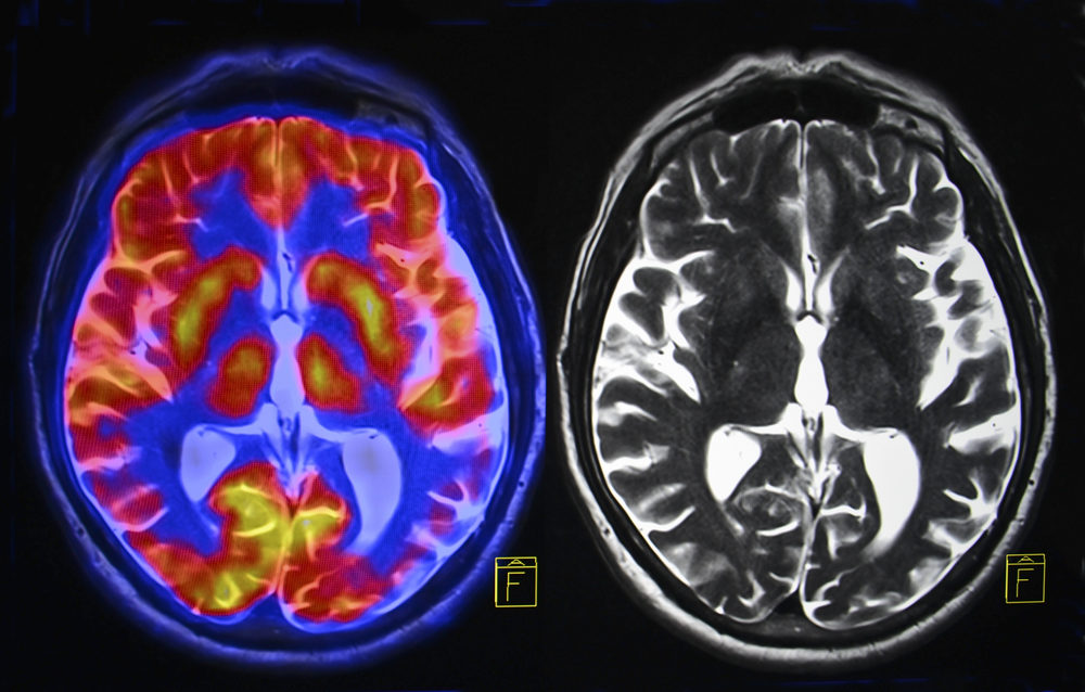 Brain Scans