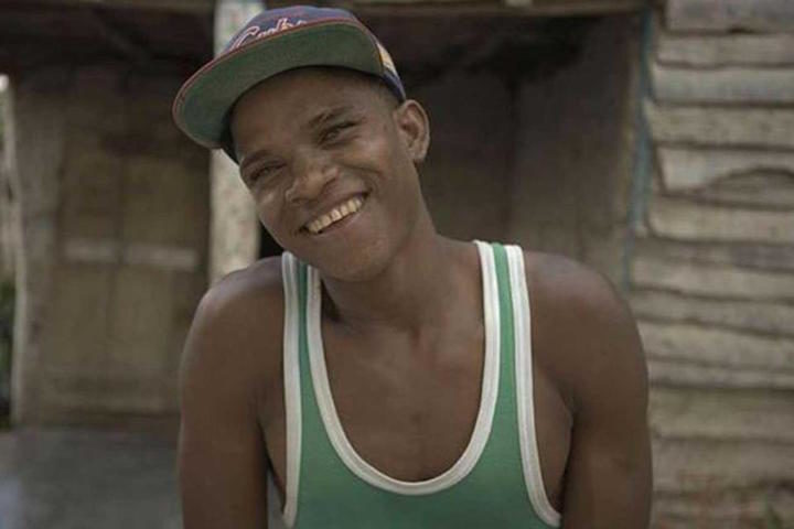 Click to enlarge genetic disorder guevedoces Dominican Republic