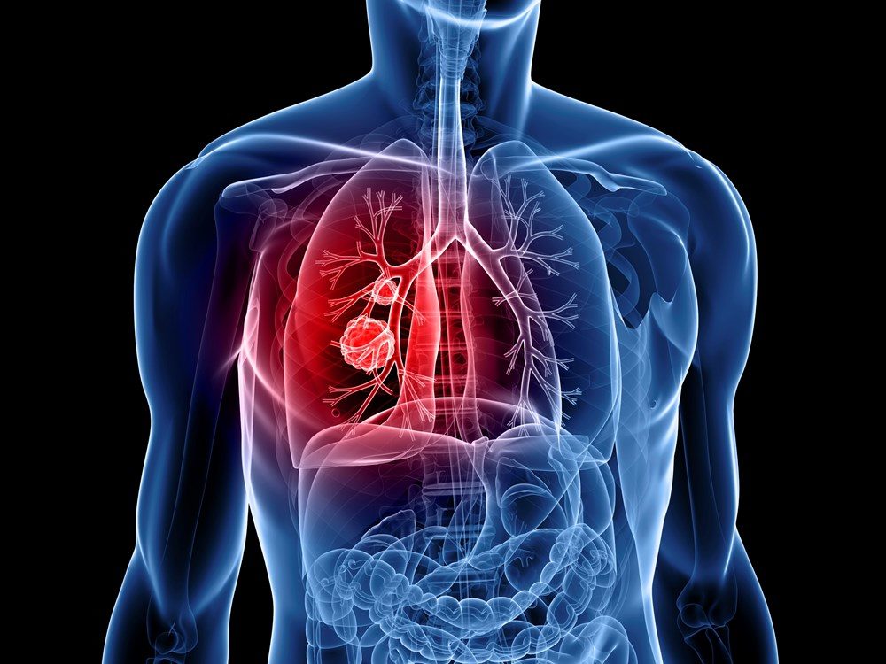 lung cancer