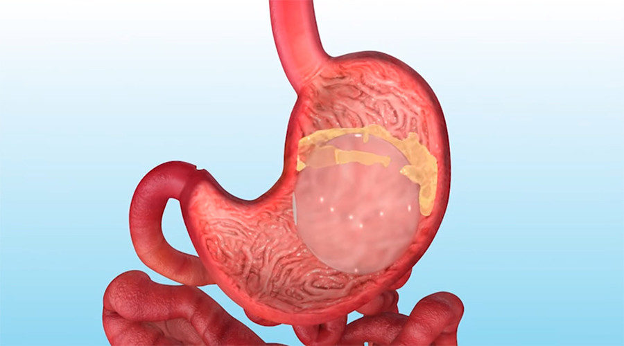 Click to enlarge stomach balloon