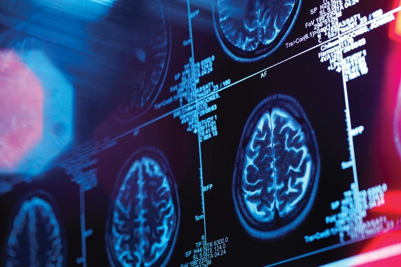 brain scan