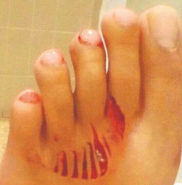An 11-year-old girl is being treated in hospital following a suspected shark at a Spanish holiday resort. Pictured: Her injuries
