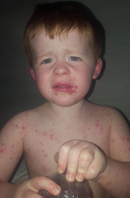 Click to enlarge hand foot mouth disease kid