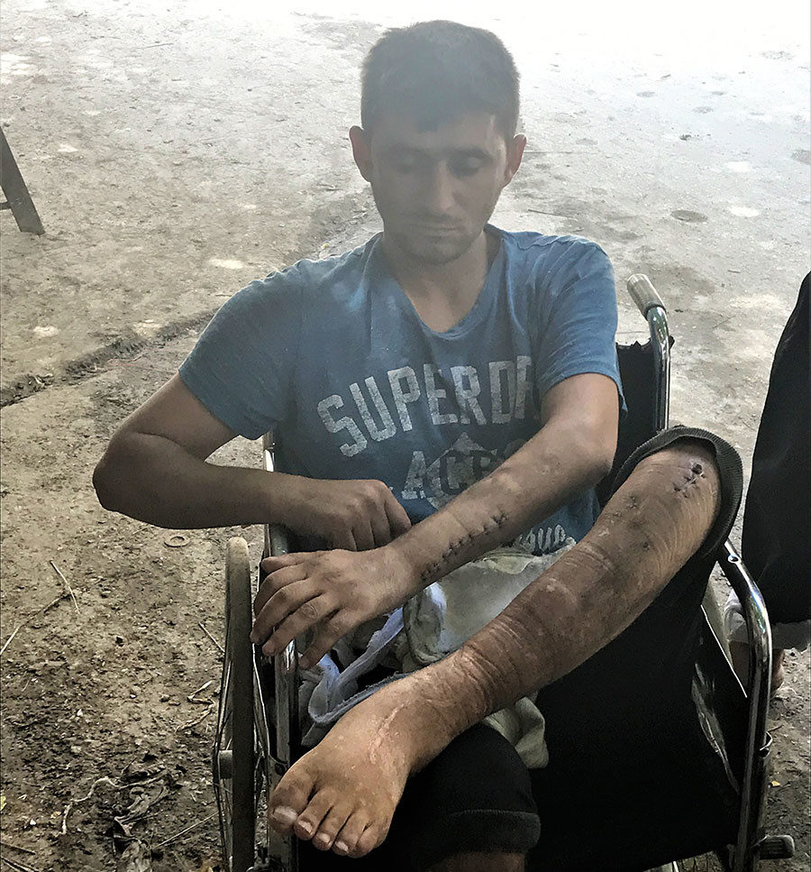 Another resident from the Qaterji area shows us his injuries from a Nusra Front mortar attack