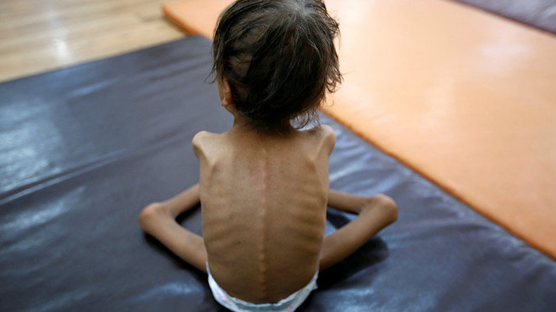 Starving child in Yemen
