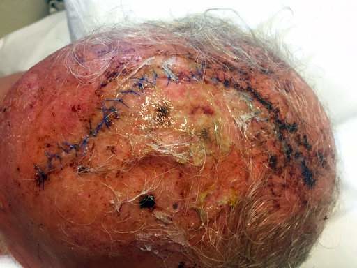 Click to enlarge This photo provided by Tom Sommer shows wounds that Sommer sustained after a grizzly bear mauled him on Monday, Sept. 4, 2017, in southwestern Montana.
