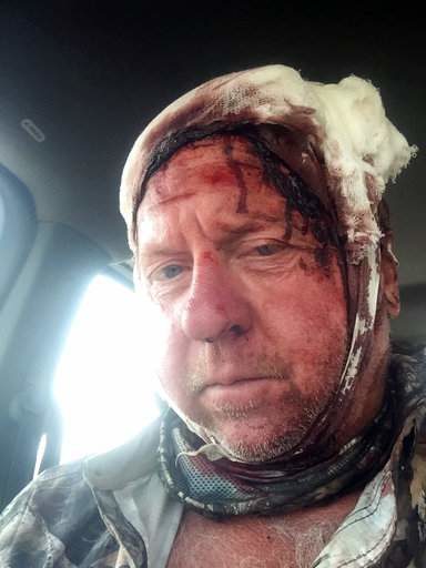 Click to enlarge This photo provided by Tom Sommer shows Sommer after a grizzly bear mauled him on Monday, Sept. 4, 2017, in southwestern Montana