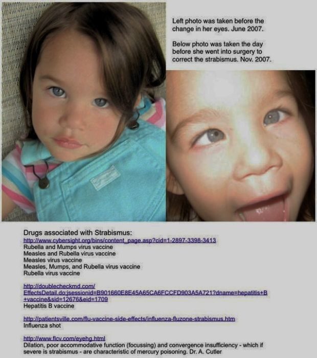 Click to enlarge vaccine induced strabismus