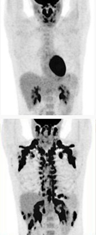 PET images brown fat