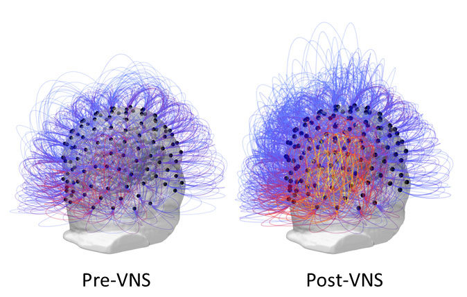 Pre and Post Vagus nerve stimulation