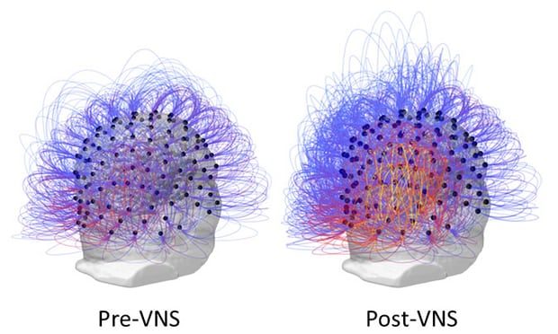 Brain VNS stimulation