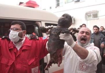 burned child Syria