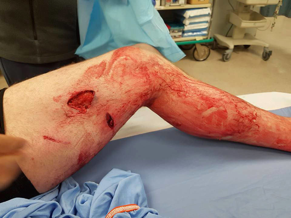 Jake Blackmore posted a picture on Facebook of his bear-bitten leg, after arriving at the Elk Valley Hospital.