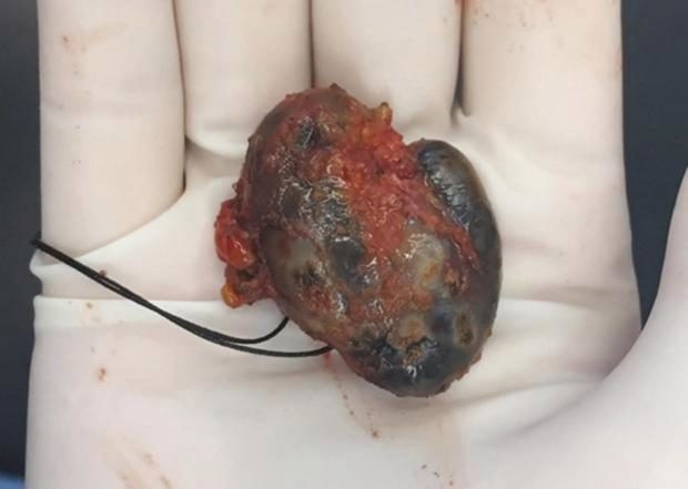 lymph node