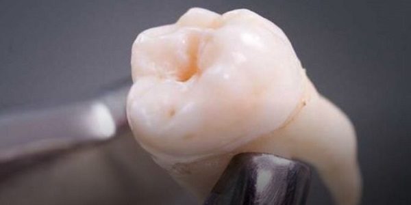 Click to enlarge tooth