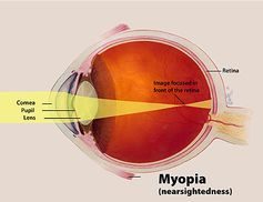 Click to enlarge myopic eye