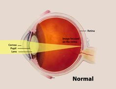 Click to enlarge A normal eye.