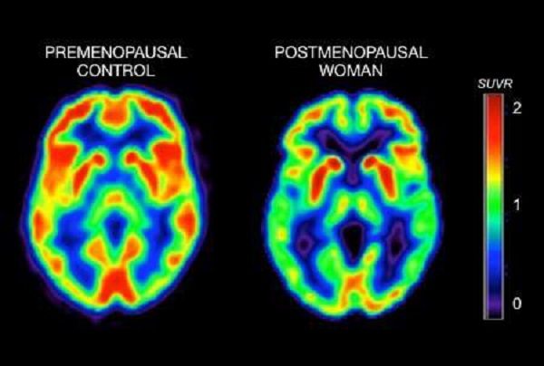 MRI's of menopausal brains