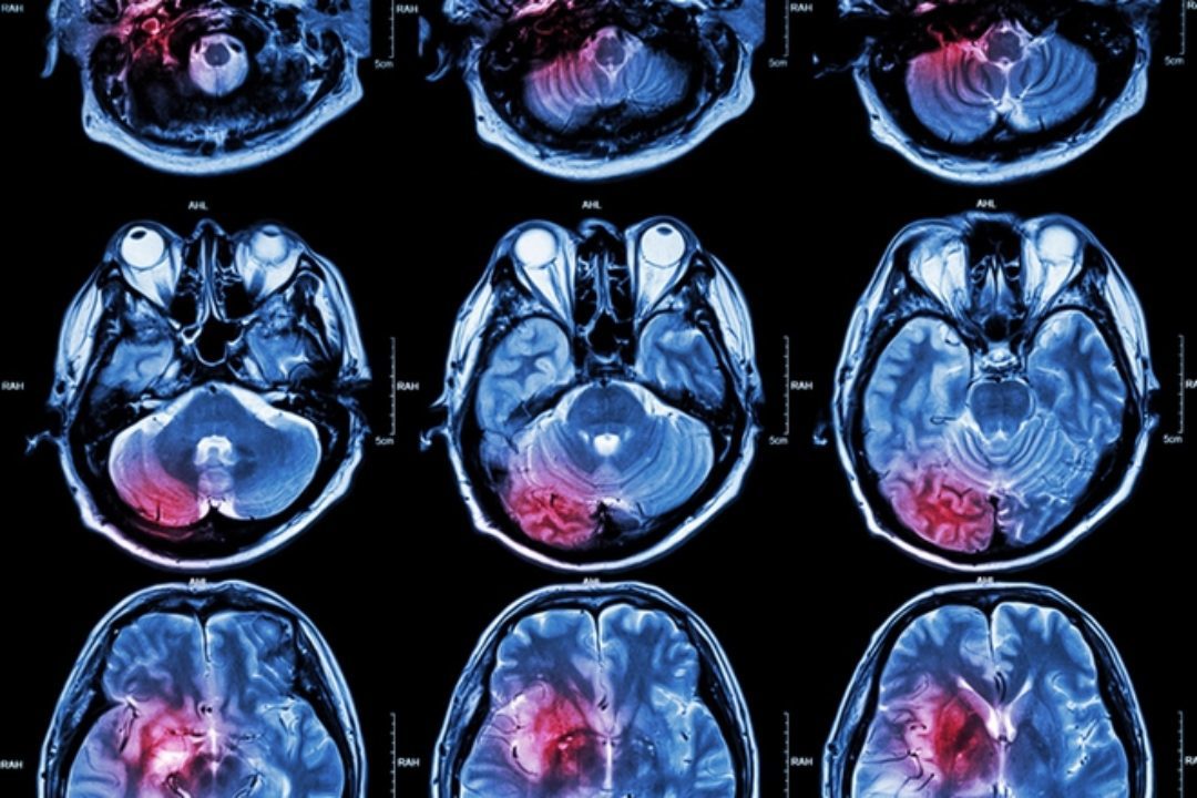 brain scan images