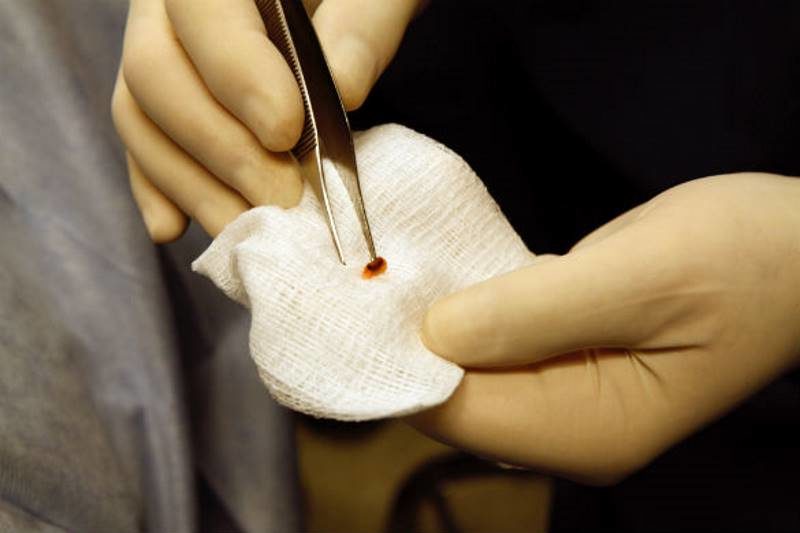 Click to enlarge alien implant removal