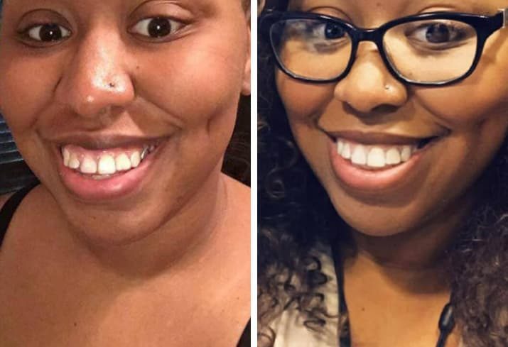 Click to enlarge Teeth straightening
