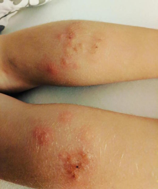 Bedbugs British Airways