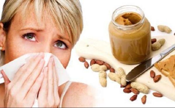 food allergies